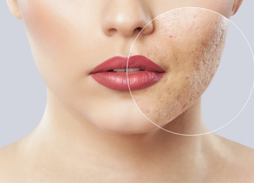 Acne Scarring Causes & Treatments