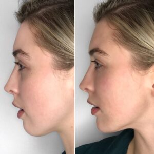 Before and after jawline contouring